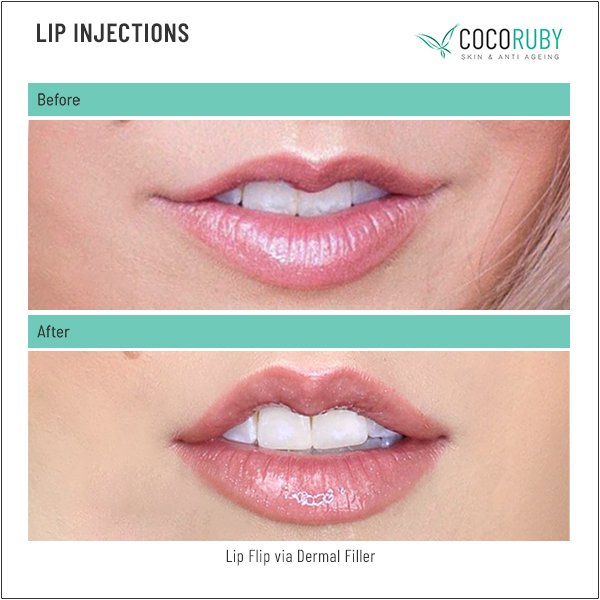 lip-injections-before-and-after-40