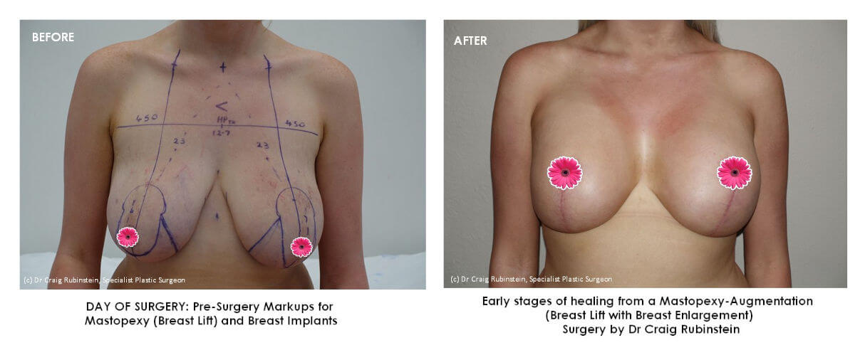 AFTER-breast-lift-mastopexy-and-breast-implant-surgery-dr-craig-rubinstein-kaitlin