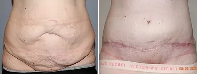 Extended Tummy Tuck/Abdominoplasty Melbourne - 1