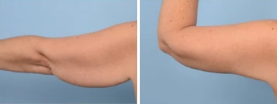 Arm Lift (Brachioplasty) Surgery Melbourne - 1
