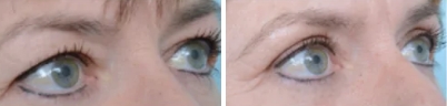 Eyelid Surgery (Blepharoplasty) for Men in Melbourne - 2