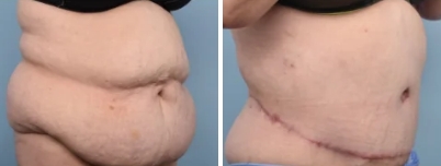 Body Lift (Thoracoplasty/Belt Lipectomy) Surgery Melbourne - 2