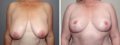 Breast Reduction Melbourne - 1