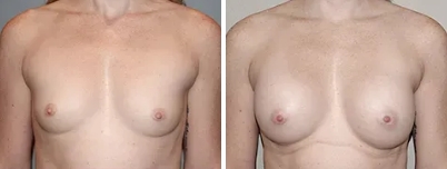 Breast Surgery Melbourne - 2