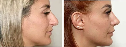 Revision Rhinoplasty | Nose Surgery Revision Melbourne - 2