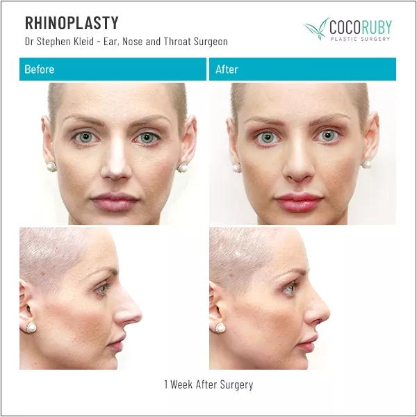Real Patient Rhinoplasty Before & After Photos in Melb VIC